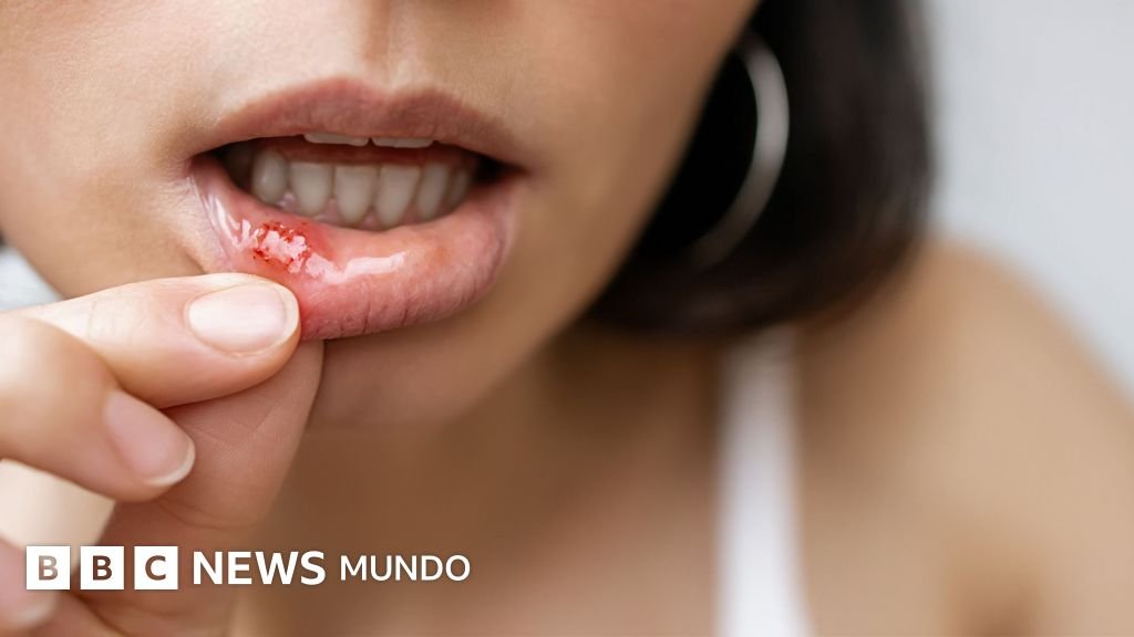 Causas de las úlceras bucales y cómo puedes aliviar sus molestias